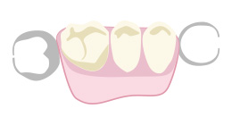 入歯やブリッジの補強のために埋入するタイプ